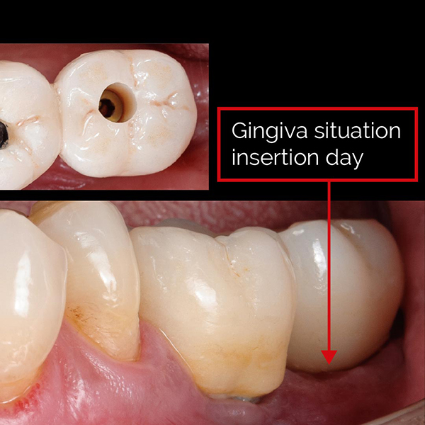 Minimally Invasive Extraction And Immediate Placement Of Patient ...